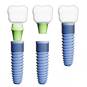 Dental Implant F