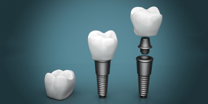'components of dental implant'